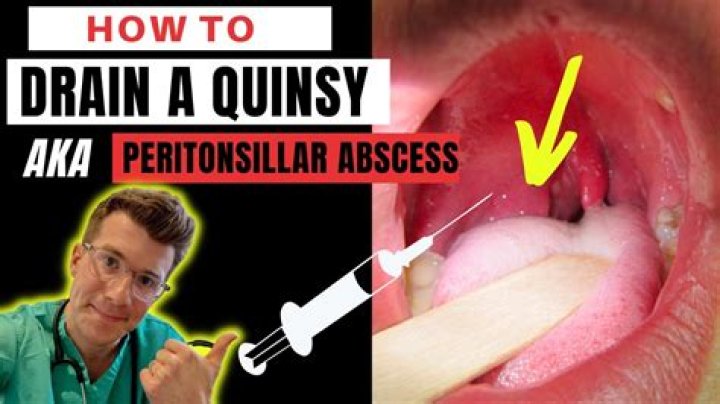 Where to drain quinsy?