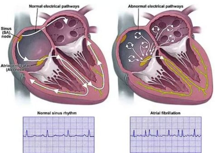 Which is more dangerous afib or aflutter?
