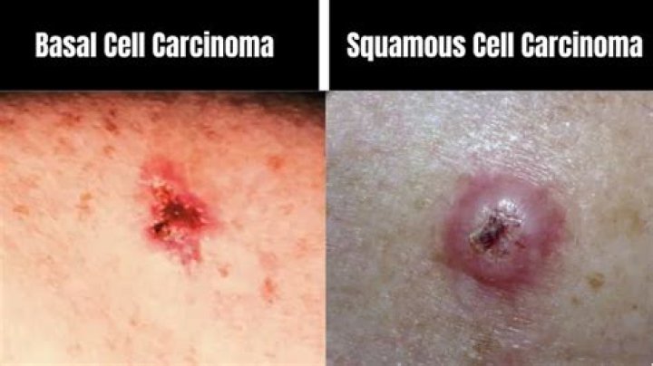 Which is worse squamous or basal cell carcinoma?