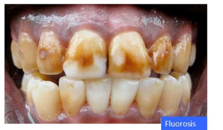 Who fluoride dental caries?