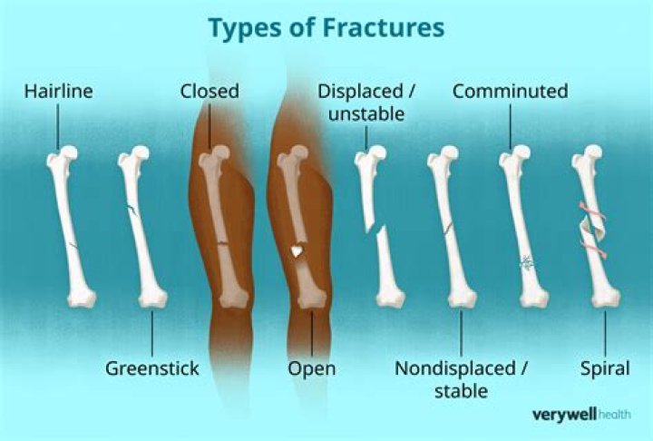 Who fragility fracture definition?