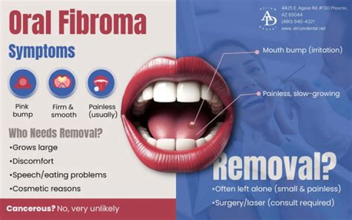 Who removes oral fibroma?