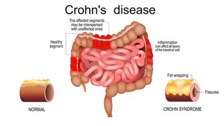 Why are crohn's patients called spoonies?