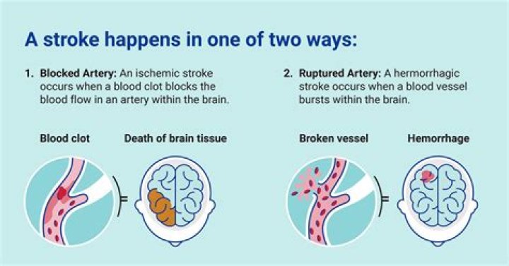 Why does stroke cause hemiplegia?