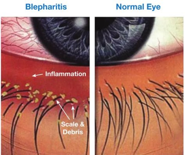 Why is blepharitis worse at night?