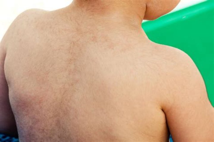 Why is it not recommended to wax lanugo hair?