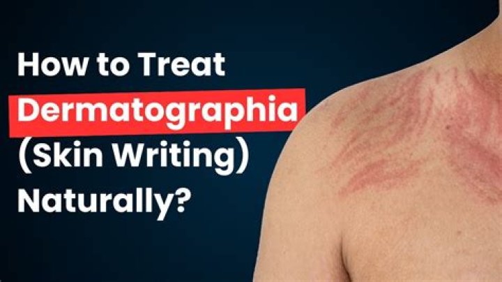 Why is my dermatographia getting worse?