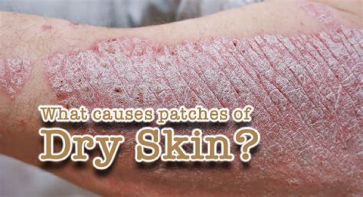 Why is my dry skin spreading?
