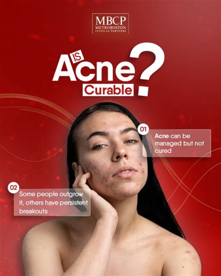 Why isn't acne curable?