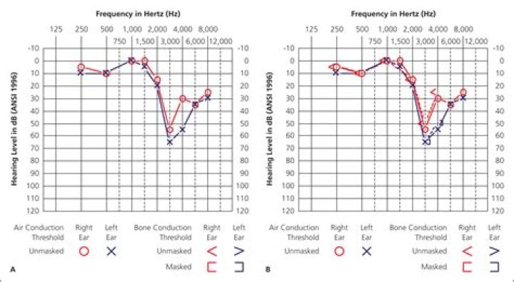 Why we use audiometry?
