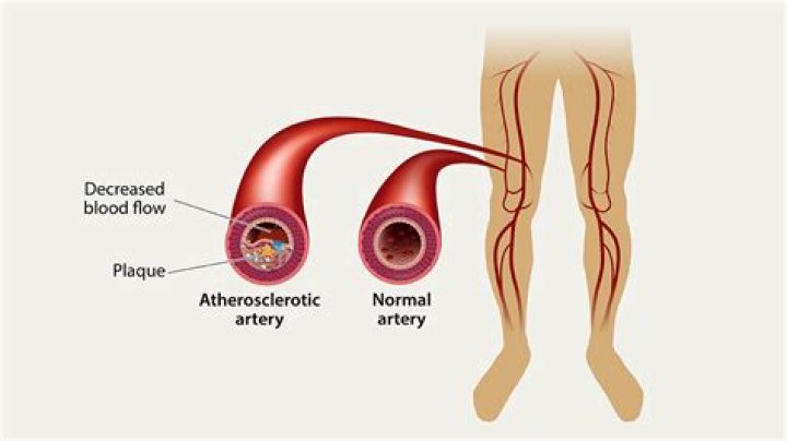 Will a blocked artery show on an ecg?