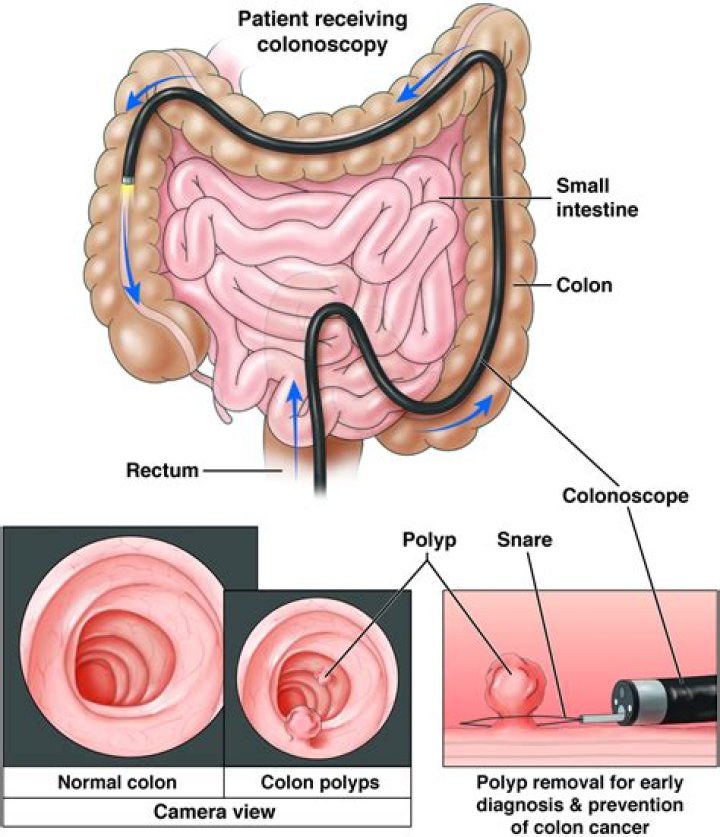 Will colonoscopy reach ileum?