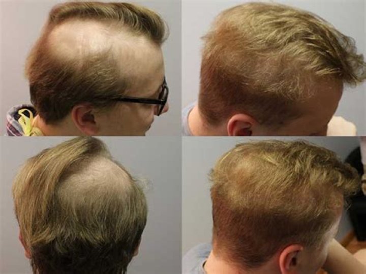 Will hair grow back after brain surgery?