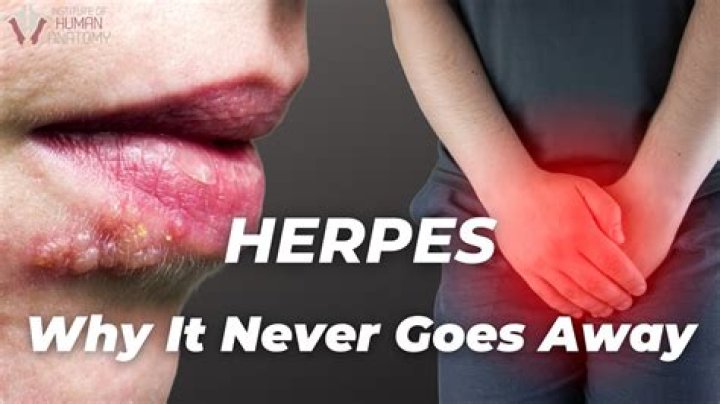 Will herpes be curable?
