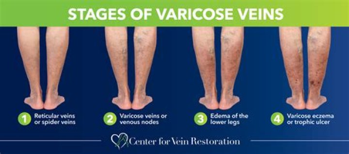 Will my phlebitis go away?