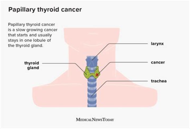 Will papillary thyroid cancer kill you?