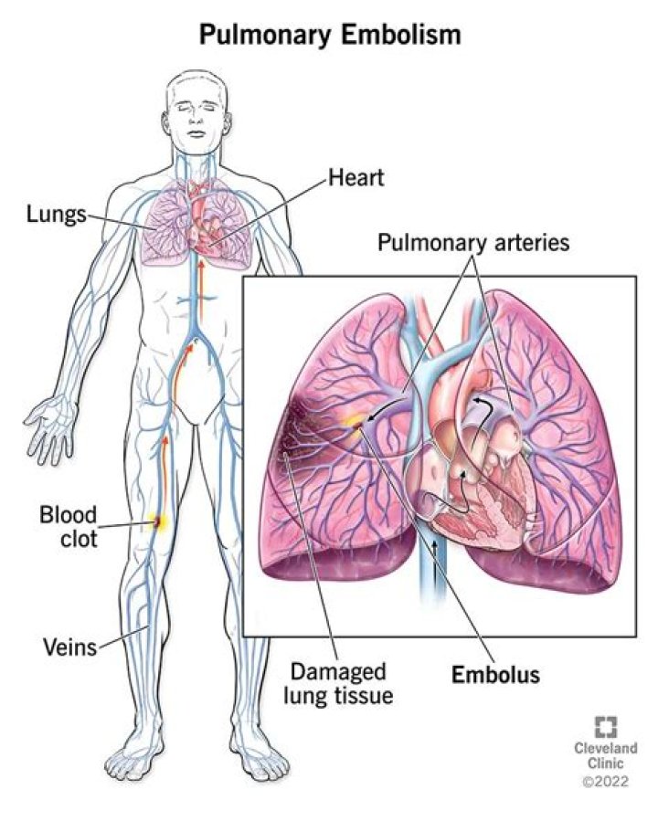 Will pulmonary embolism go away?