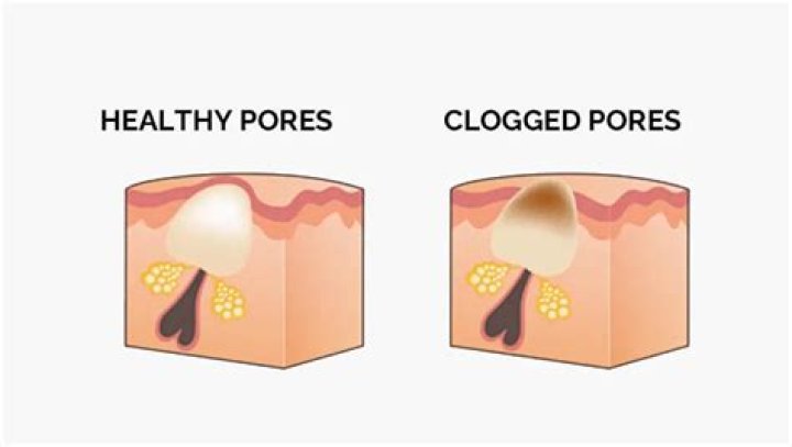 Will sebum clog pores?