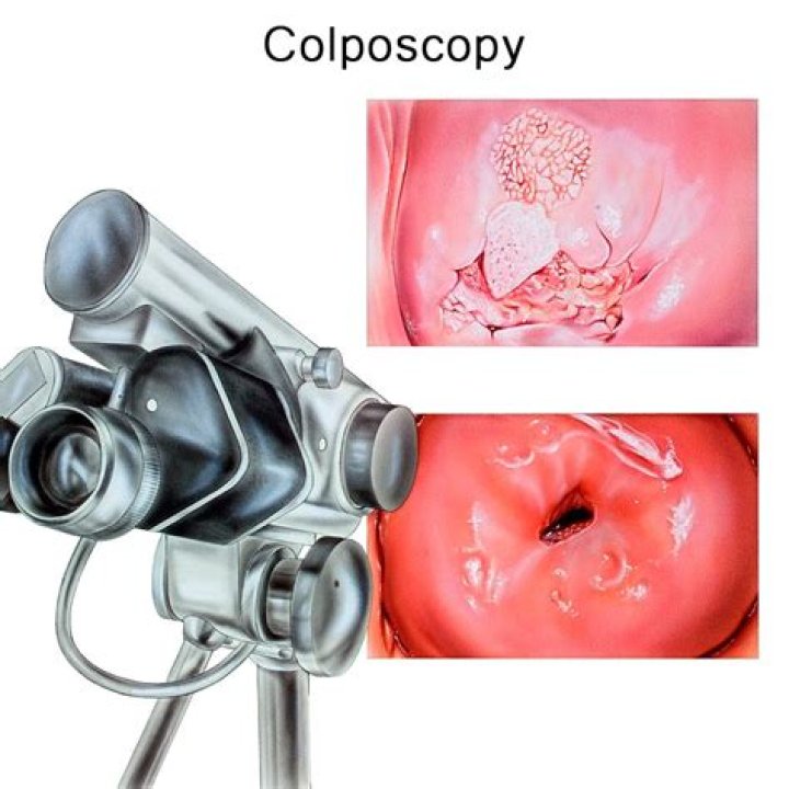 Would a colposcopy show hiv?