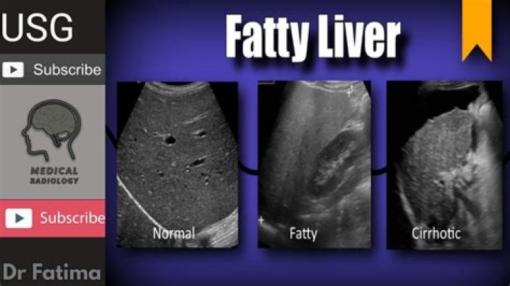 Would a ct scan show fatty liver?