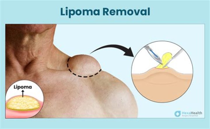 Would a dermatologist remove a lipoma?