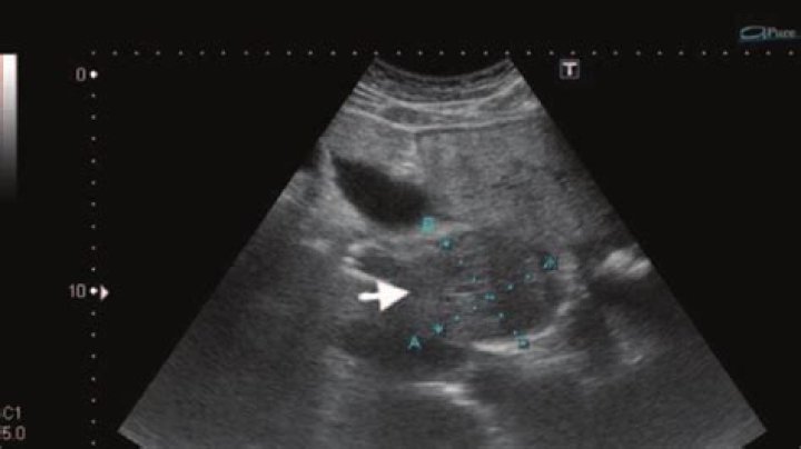 Would ultrasound show cancer?